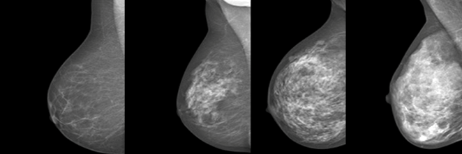 Mammografibilder av bryster med tett brystvev